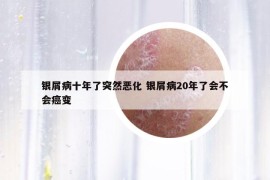 银屑病十年了突然恶化 银屑病20年了会不会癌变