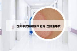 沈阳牛皮癣谓南风超好 沈阳治牛皮