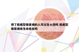 得了脓疱型银屑病的人可以生小孩吗 脓疱型银屑病有生命危险吗