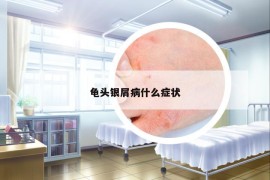 龟头银屑病什么症状