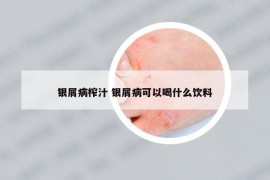 银屑病榨汁 银屑病可以喝什么饮料