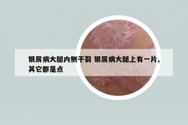 银屑病大腿内侧干裂 银屑病大腿上有一片,其它都是点