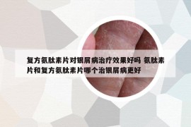 复方氨肽素片对银屑病治疗效果好吗 氨肽素片和复方氨肽素片哪个治银屑病更好