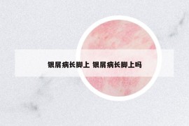 银屑病长脚上 银屑病长脚上吗