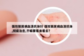 强效银屑病血清抗体针 强效银屑病血清抗体,彻底治愈,干嘛要看来看去?