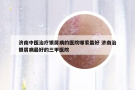 济南中医治疗银屑病的医院哪家最好 济南治银屑病最好的三甲医院