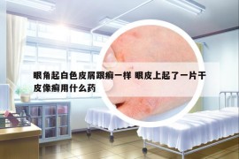 眼角起白色皮屑跟癣一样 眼皮上起了一片干皮像癣用什么药