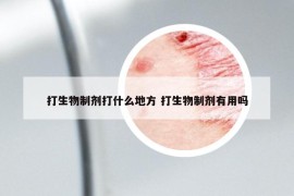 打生物制剂打什么地方 打生物制剂有用吗