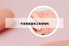 牛皮癣患者身上有怪味吗