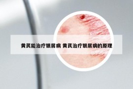 黄芪能治疗银屑病 黄芪治疗银屑病的原理