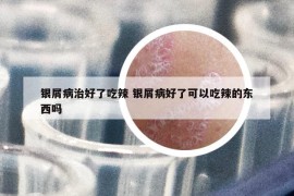 银屑病治好了吃辣 银屑病好了可以吃辣的东西吗