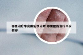 哪里治疗牛皮癣能根治呢 哪里医院治疗牛皮癣好