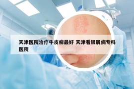 天津医院治疗牛皮癣最好 天津看银屑病专科医院