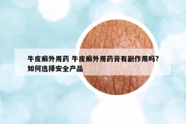 牛皮癣外用药 牛皮癣外用药膏有副作用吗?如何选择安全产品