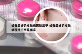 长春最好的皮肤病医院三甲 长春最好的皮肤病医院三甲是哪家