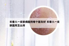 长春八一皮肤病医院哪个医生好 长春八一皮肤医院怎么样