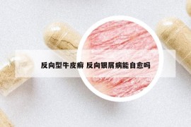 反向型牛皮癣 反向银屑病能自愈吗