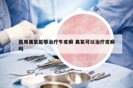 医用臭氧能够治疗牛皮癣 臭氧可以治疗皮癣吗