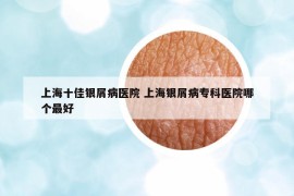 上海十佳银屑病医院 上海银屑病专科医院哪个最好
