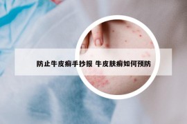 防止牛皮癣手抄报 牛皮肤癣如何预防