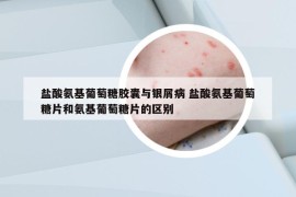 盐酸氨基葡萄糖胶囊与银屑病 盐酸氨基葡萄糖片和氨基葡萄糖片的区别