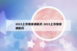 2023上市银屑病新药 2019上市银屑病新药