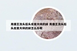 用康王洗头后头皮屑大块的掉 用康王洗头后头皮屑大块的掉怎么办呢