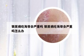 银屑病吃海带会严重吗 银屑病吃海带会严重吗怎么办