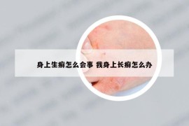 身上生癣怎么会事 我身上长癣怎么办