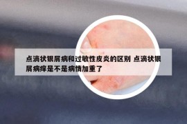 点滴状银屑病和过敏性皮炎的区别 点滴状银屑病痒是不是病情加重了
