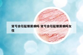 肾亏会引起银屑病吗 肾亏会引起银屑病吗女性
