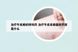 治疗牛皮癣的特效药 治疗牛皮皮癣最好药膏是什么