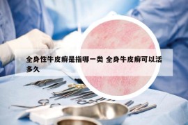 全身性牛皮癣是指哪一类 全身牛皮癣可以活多久