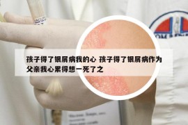 孩子得了银屑病我的心 孩子得了银屑病作为父亲我心累得想一死了之