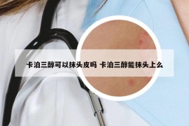 卡泊三醇可以抹头皮吗 卡泊三醇能抹头上么