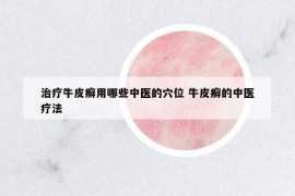 治疗牛皮癣用哪些中医的穴位 牛皮癣的中医疗法