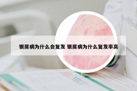银屑病为什么会复发 银屑病为什么复发率高