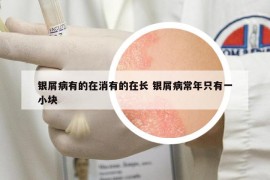 银屑病有的在消有的在长 银屑病常年只有一小块