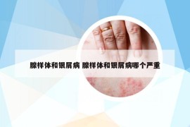 腺样体和银屑病 腺样体和银屑病哪个严重