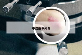 牛皮癣中间白