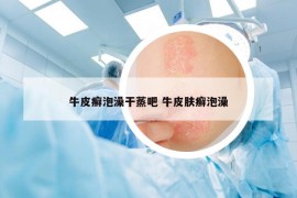 牛皮癣泡澡干蒸吧 牛皮肤癣泡澡