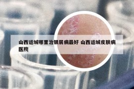 山西运城哪里治银屑病最好 山西运城皮肤病医院