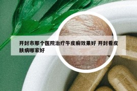 开封市那个医院治疗牛皮癣效果好 开封看皮肤病哪家好