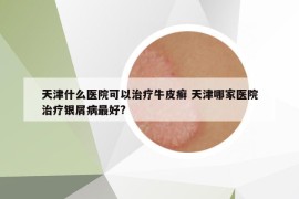 天津什么医院可以治疗牛皮癣 天津哪家医院治疗银屑病最好?