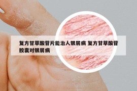 复方甘草酸苷片能治人银屑病 复方甘草酸苷胶囊对银屑病