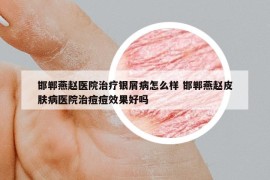 邯郸燕赵医院治疗银屑病怎么样 邯郸燕赵皮肤病医院治痘痘效果好吗