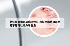 急性点滴状银屑病遗传吗 急性点滴状银屑病是不是可以终身不复发