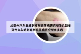 从郑州汽车北站到郑州银屑病研究所坐几路车 郑州火车站到郑州银屑病研究所有多远