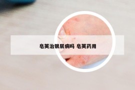 皂荚治银屑病吗 皂荚药用