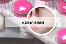 南京哪治牛皮癣最好